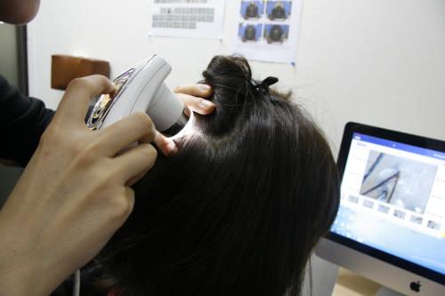 韩医治疗男性型女性脱发症状方案